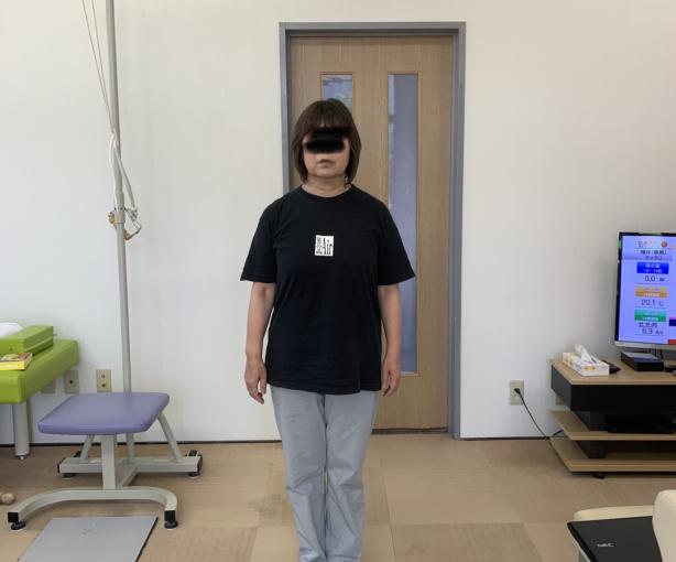 なで肩の改善before after