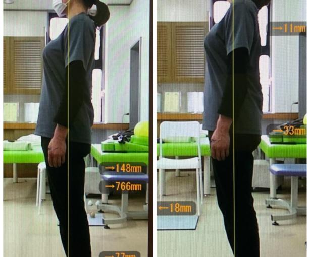 脚軸トレーニングで骨盤を矯正しました。
