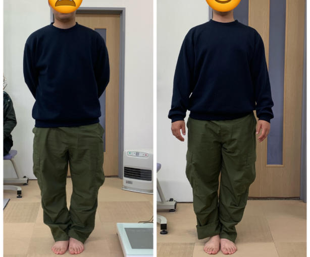 Ｏ脚のビフォーアフター