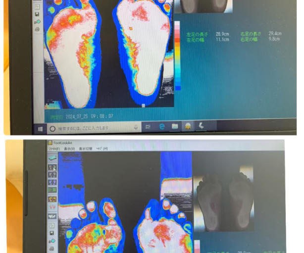 コロコロさんを使って重度の坐骨神経痛が改善。扁平足も改善してきました。